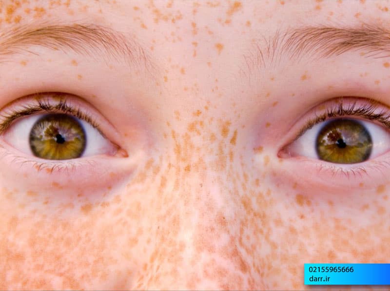 درمان کک و مک : کک مک چیست و چگونه می توان از آن خلاص شد؟