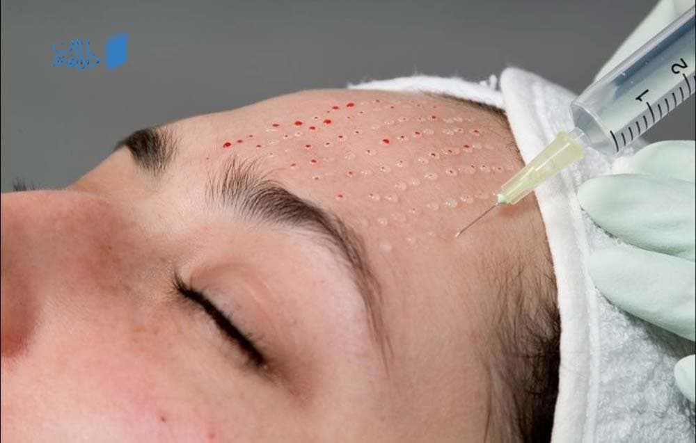 مزوتراپی چیست؟